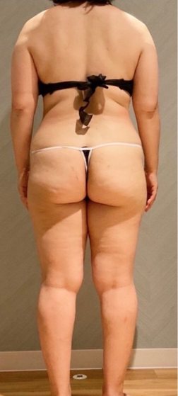 40代 全身ガリ痩せスリム 施術前